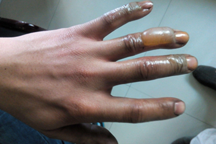 电弧烧伤水疱图 电弧烧伤水疱图