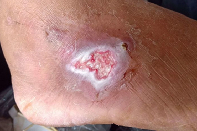 Ⅰ级糖尿病足症状图