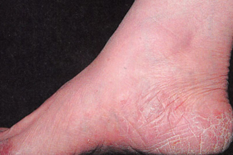 鳞屑角化型足藓图 鳞屑角化型足藓图