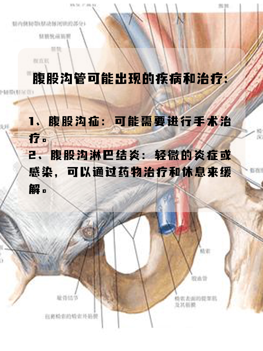 腹股沟管：连接身体的“通道”，你了解多少？