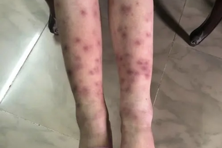 结节性红斑图 结节性红斑图