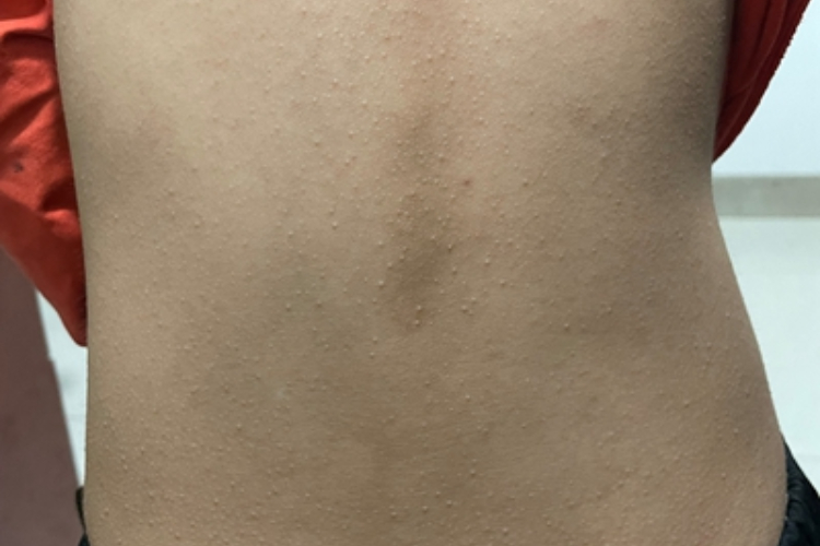 光泽苔藓背部有小丘疹图 光泽苔藓背部有小丘疹图