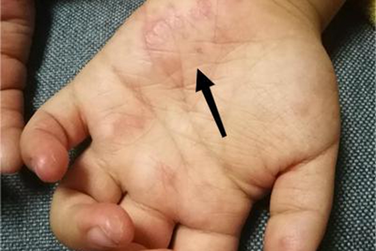 胆碱能性荨麻疹手掌症状图