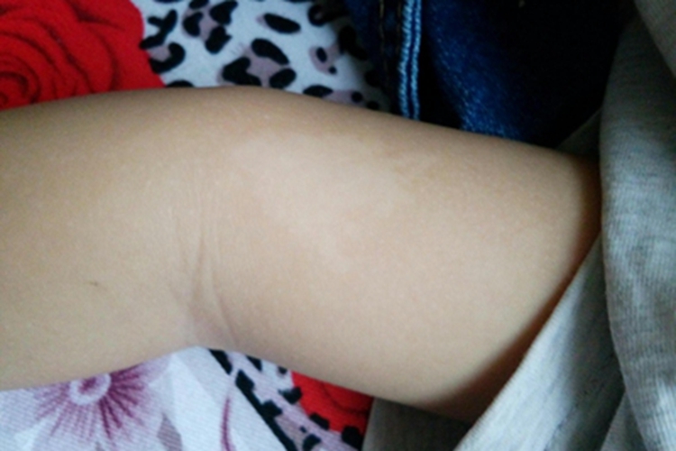 无色素痣胳膊症状图 无色素痣胳膊症状图