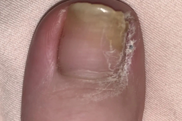 慢性甲沟炎皮肤增厚图 慢性甲沟炎皮肤增厚图