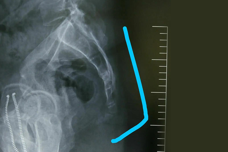 骶尾发育异常尾骨突出图