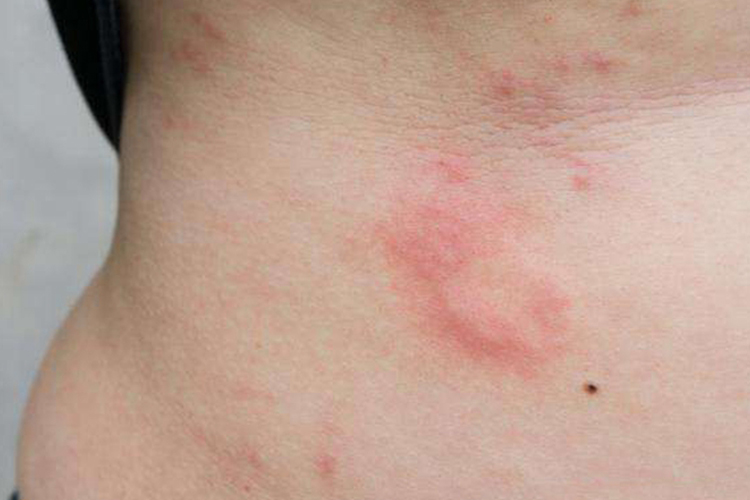 黑色的虫子咬人很疼会肿图