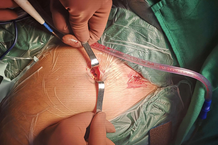 锁骨骨折微创手术图