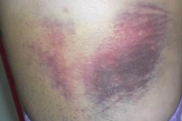 外伤后背淤血图 外伤后背淤血图