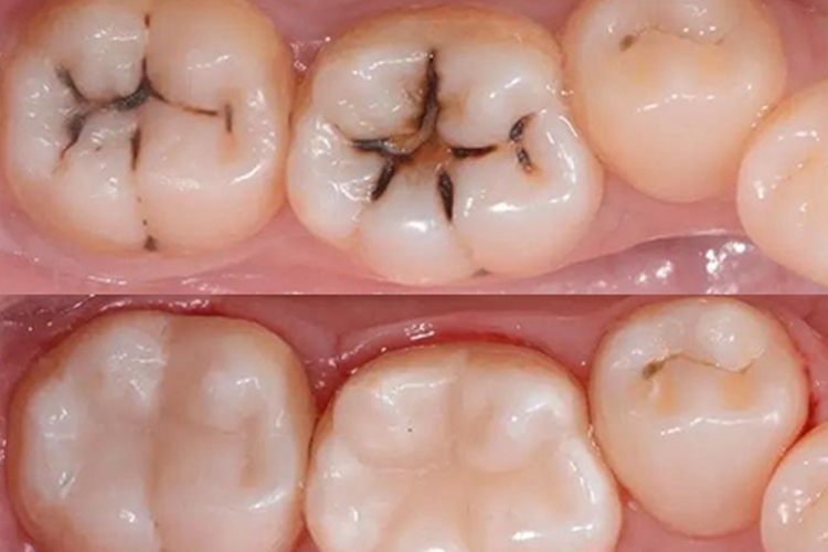玻璃离子水门汀补牙图 玻璃离子水门汀补牙图
