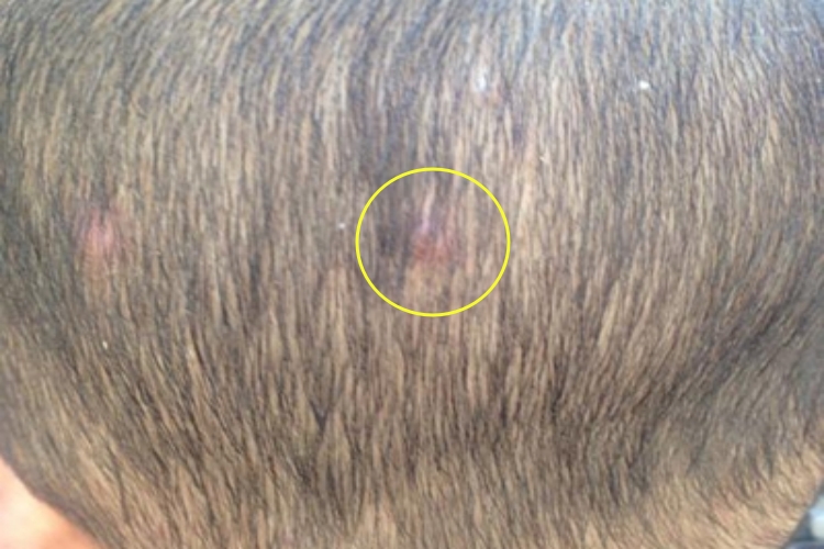 水痘枕后长一个红疙瘩图