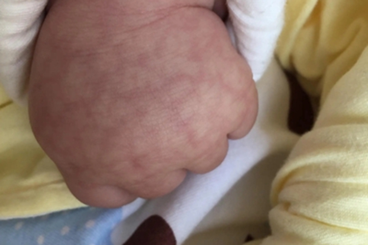 生理性网状青斑手背症状图