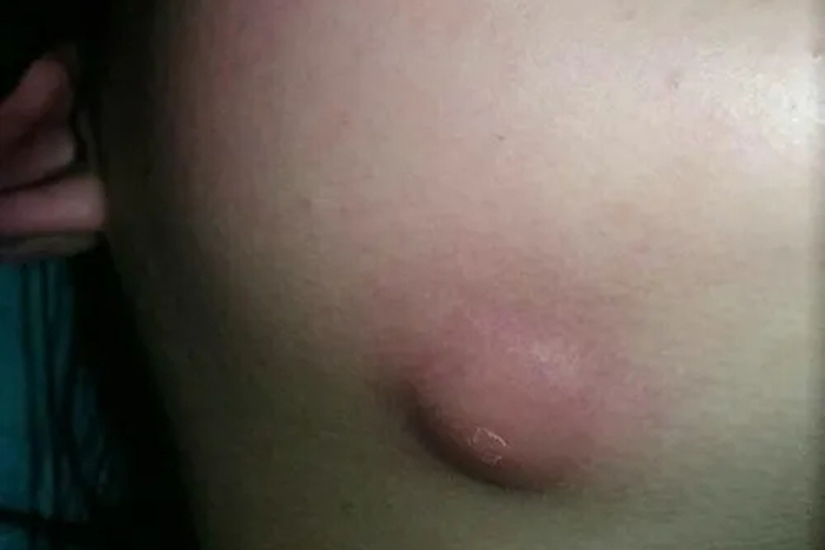 小孩疖下巴有个硬块图