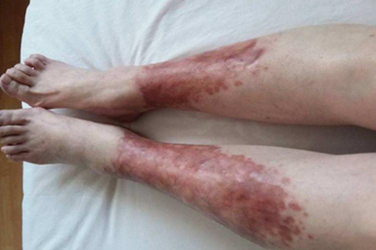 类脂质渐进性坏死脚踝红斑图