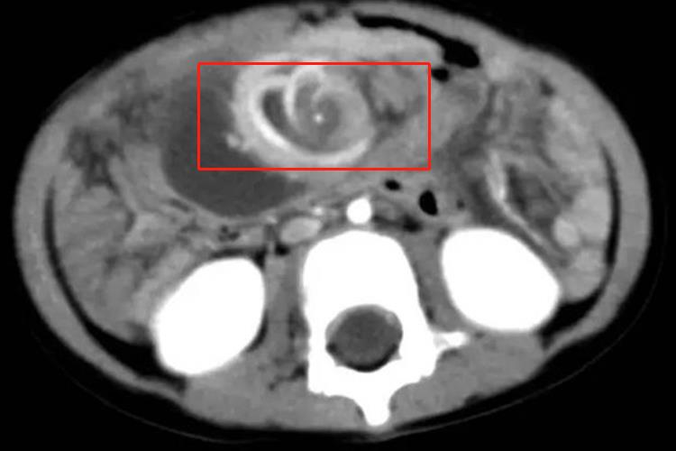 肠扭转CT表现图 肠扭转CT表现图