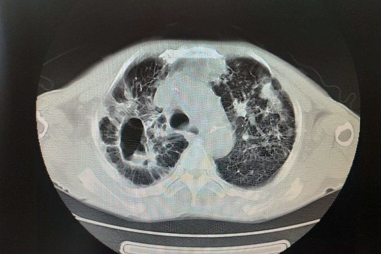 空洞型肺结核ct图