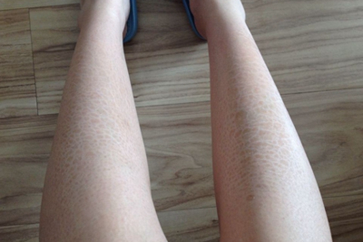 缺铁性贫血皮肤粗糙图