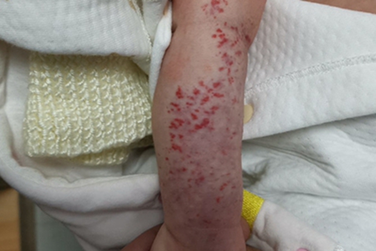 海绵状血管瘤胳膊症状图