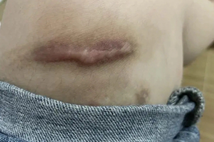 瘢痕疙瘩大腿长条状的疙瘩图