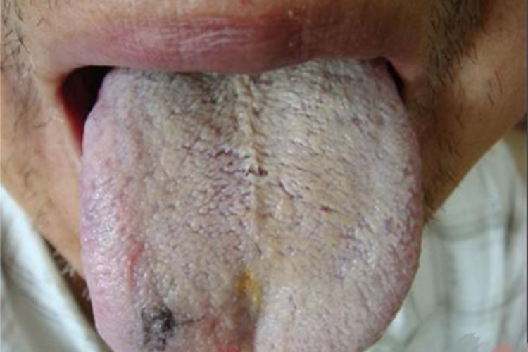 毛舌舌头全都是白色的图 毛舌舌头全都是白色的图