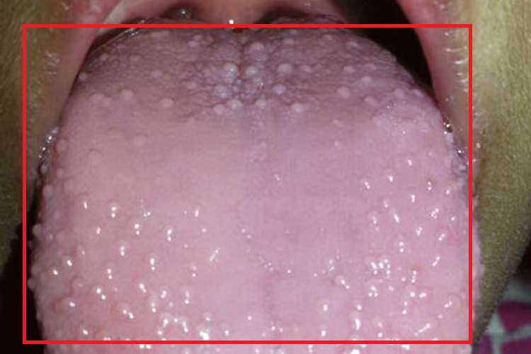 舌背轮廓乳头炎图 舌背轮廓乳头炎图