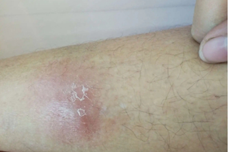 结节性结核性静脉炎小腿结节图 结节性结核性静脉炎小腿结节图