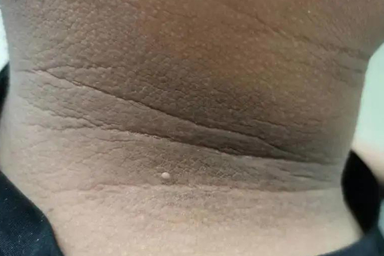 色素沉着伴天鹅绒增生图