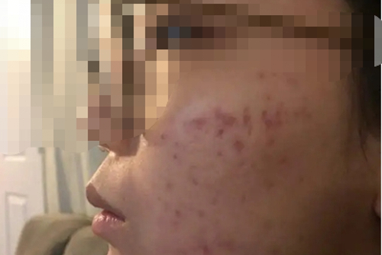 化妆品性痤疮面部红斑图