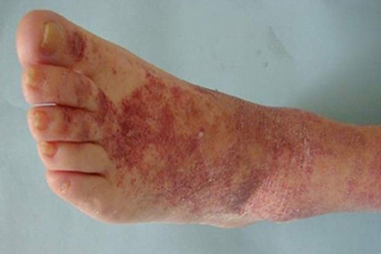 色素性紫癜性苔藓样皮炎红斑图 色素性紫癜性苔藓样皮炎红斑图