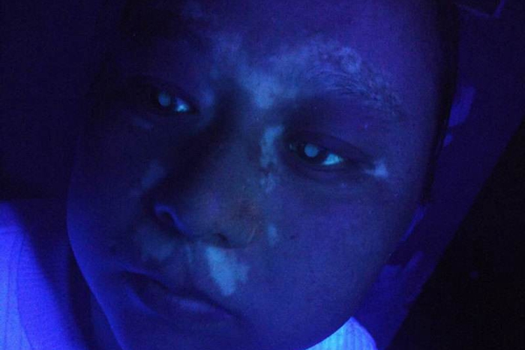 白癜风伍德灯下表现图