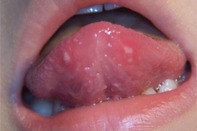 原发性疱疹性龈口炎舌头白点图 原发性疱疹性龈口炎舌头白点图