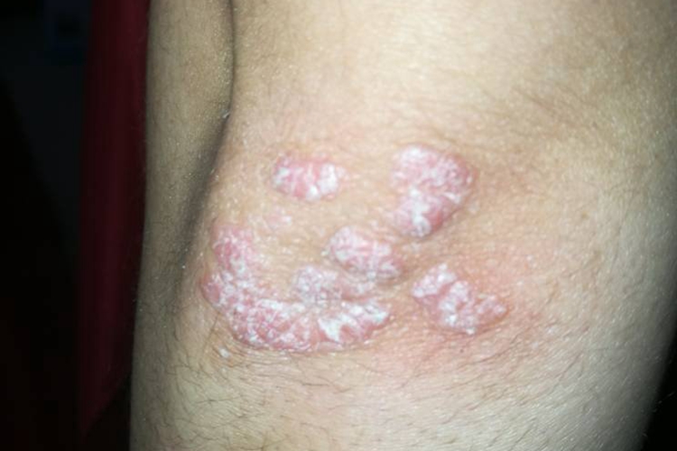 神经性皮炎图 神经性皮炎图