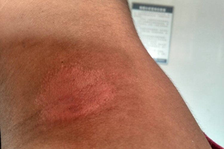 糙皮病侧颈症状图 糙皮病侧颈症状图