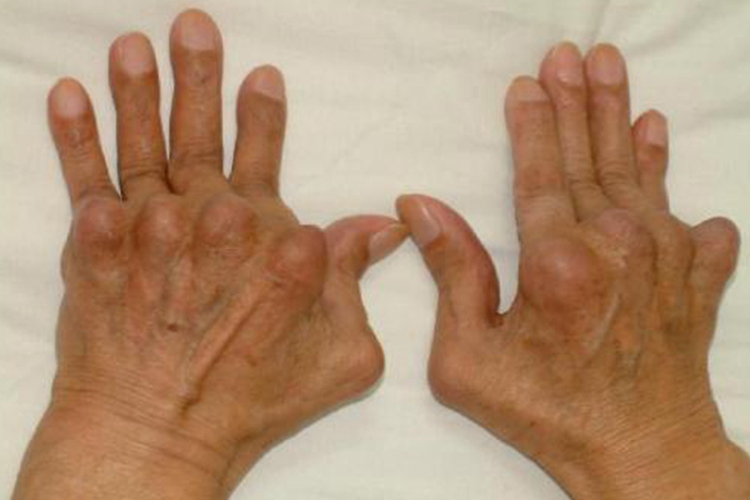 类风湿性关节炎关节畸形图 类风湿性关节炎关节畸形图