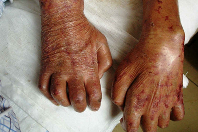 界限类偏瘤型麻风手部症状图