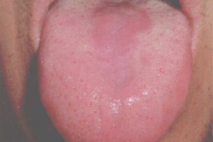 根剥苔图 根剥苔图