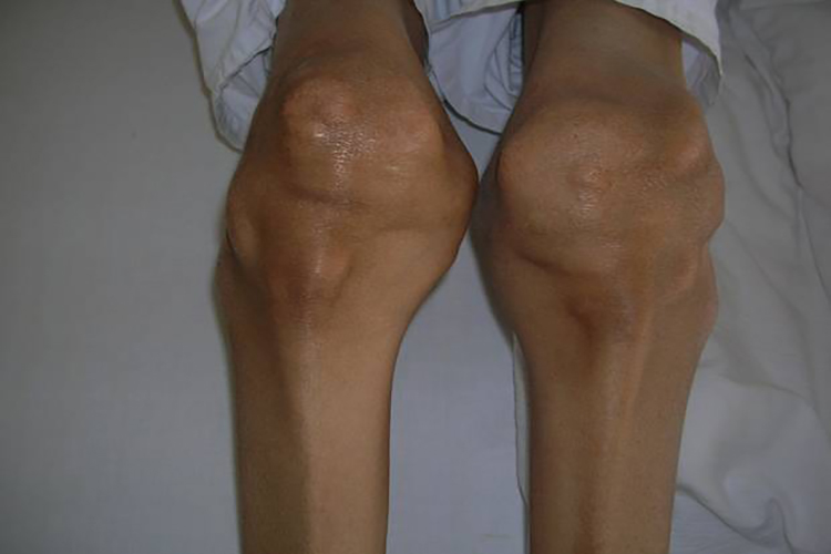 膝关节处痛风石图