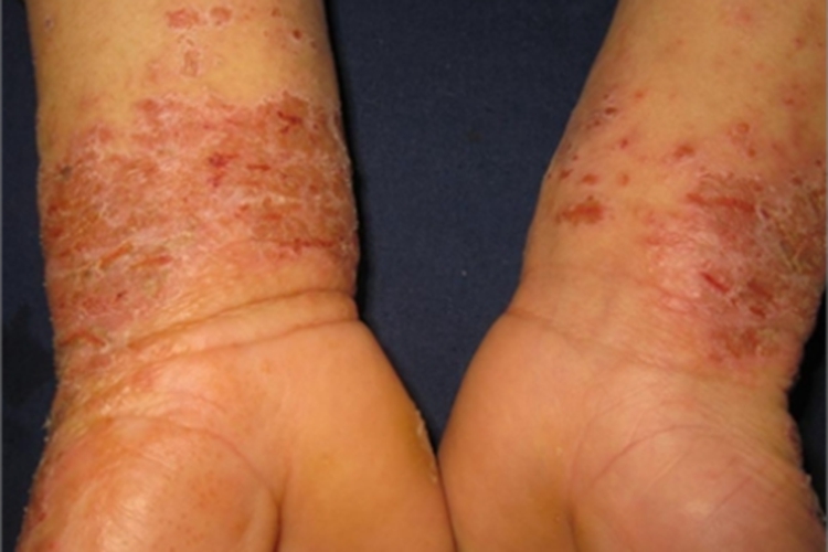 皮革皮炎手腕表面结痂图 皮革皮炎手腕表面结痂图