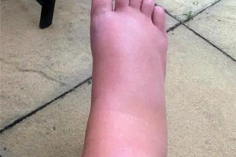 特发性水肿脚面鼓起来图