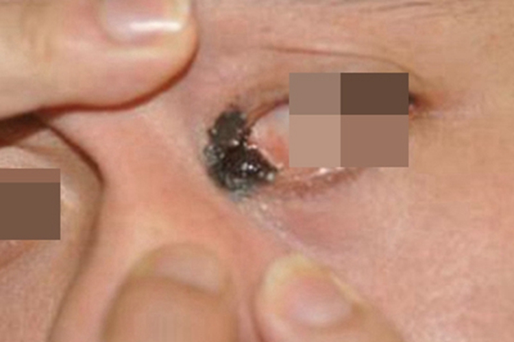 眼睑复合痣眼角症状图