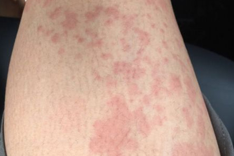 杨梅过敏皮肤红斑图