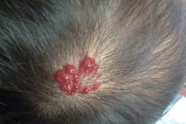 血管瘤头部红斑图 血管瘤头部红斑图