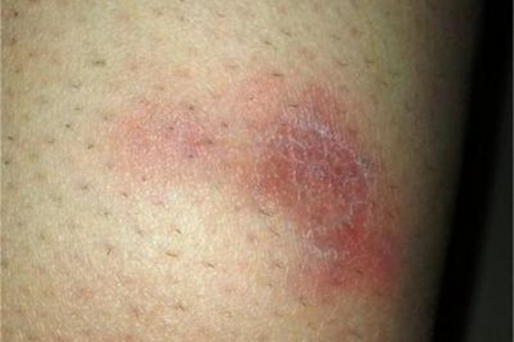 结节性脂膜炎大腿红斑图