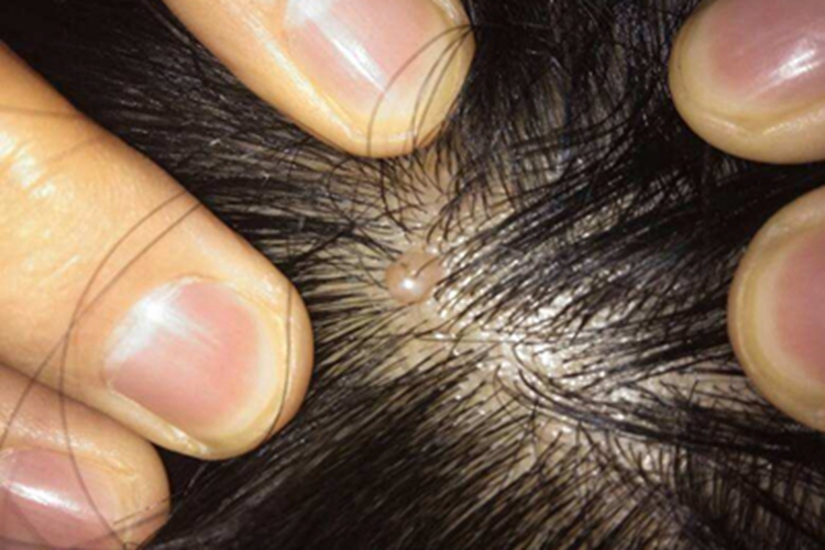 毛囊上皮瘤头部长疙瘩图