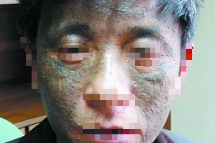 皮肤黑变病面部皮肤发黑图 皮肤黑变病面部皮肤发黑图