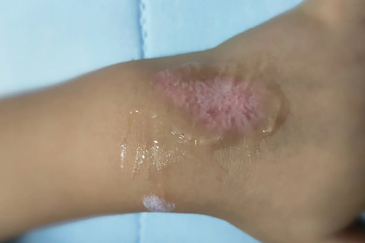 小孩手背擦伤痂皮脱落图 小孩手背擦伤痂皮脱落图