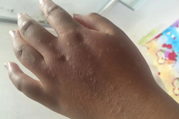 手背日光性荨麻疹风团图
