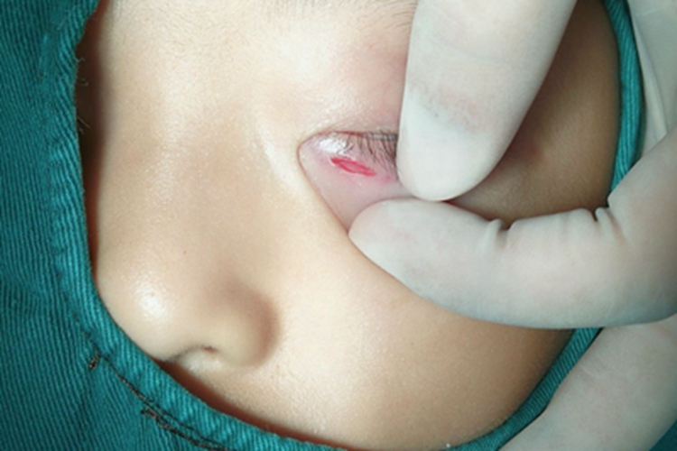 裂伤眼睑症状图