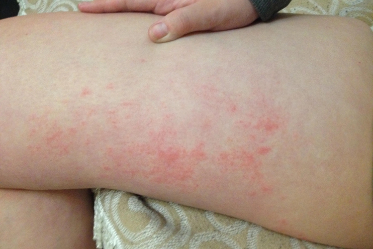 下肢接触性皮炎图