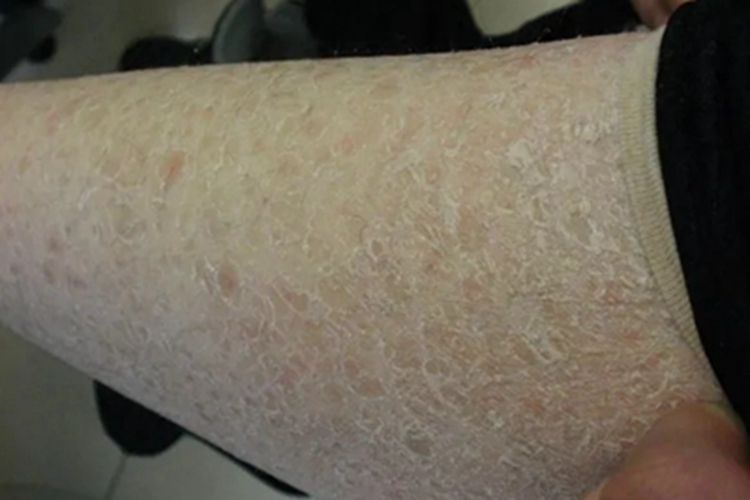 无汗症小腿症状图 无汗症小腿症状图